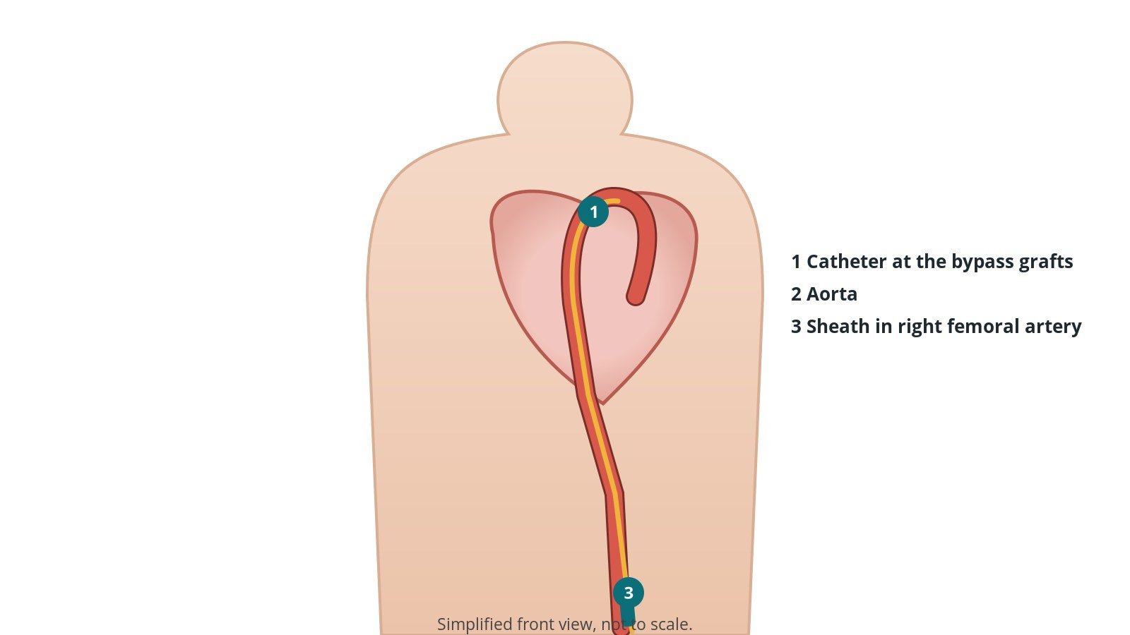 Front view of a patient showing a catheter from the right femoral artery in the groin up the aorta towards the heart
