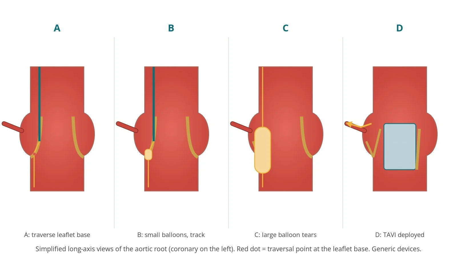 Four-panel diagram of LLAMACORN: electrified wire crossing the base of a leaflet, small balloon widening the hole, large balloon tearing the leaflet, and TAVI valve deployed with the torn leaflet splayed