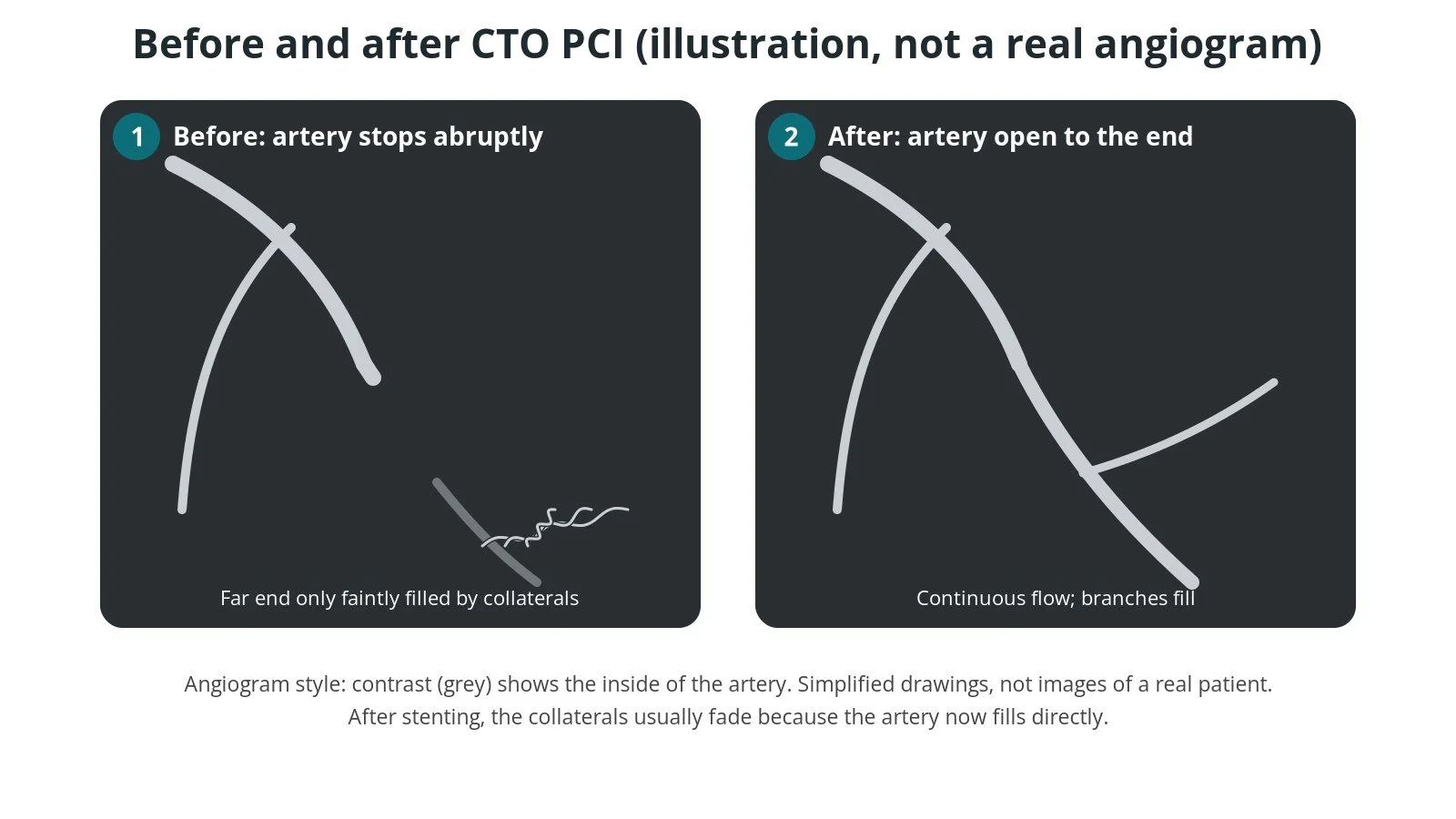 Illustrated angiogram before and after CTO PCI: before, the artery stops abruptly and its far end fills faintly through collaterals; after, the artery is open to the end with its branches filling