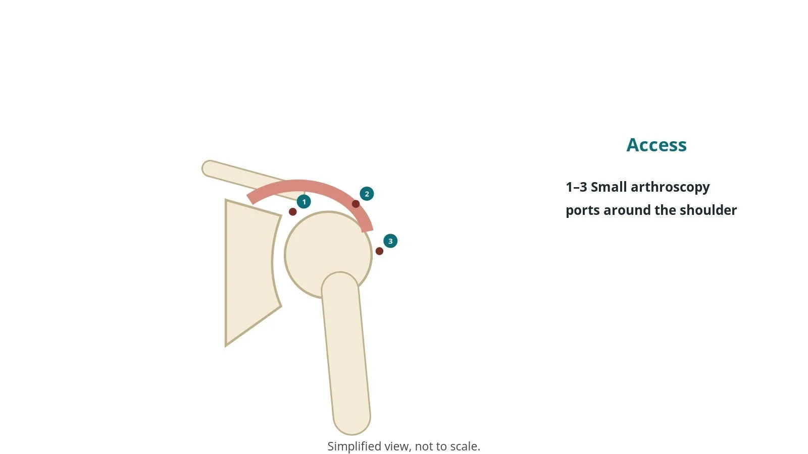 Diagram of the shoulder showing three small port sites around the joint