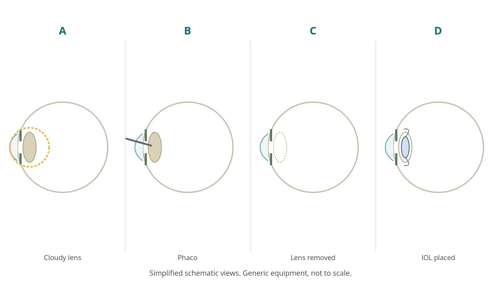 Four-panel schematic of cataract surgery: cloudy lens, phaco, lens removed, iol placed