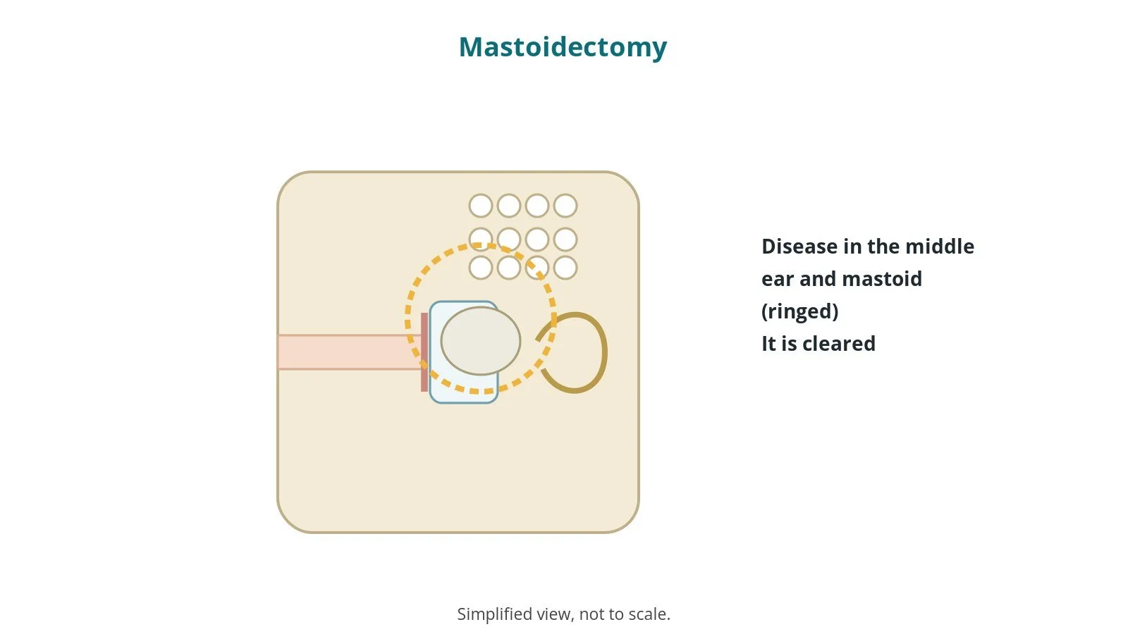 Diagram of the ear canal, eardrum and middle ear with mastoid air cells and disease ringed