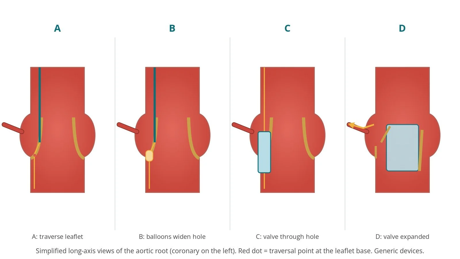 Four-panel diagram of UNICORN: electrified wire crossing the lower leaflet, balloon widening the hole, valve crossing through the hole, and valve expanded with the leaflet pushed aside