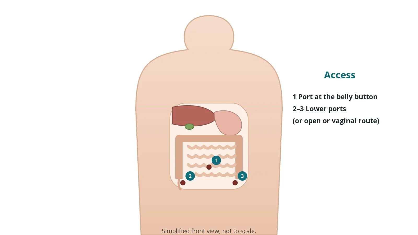 Front view of a patient showing a belly button port and two lower abdominal port sites