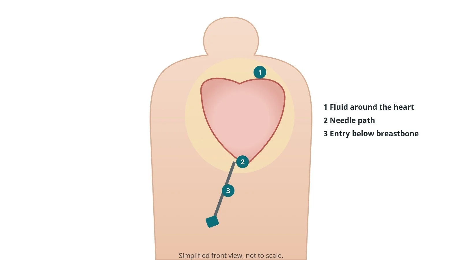 Front view of a patient showing a needle entering just below the breastbone and angled up towards the fluid around the heart