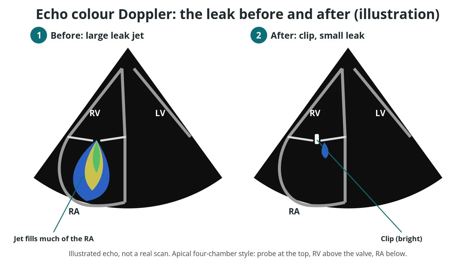 Illustration of the colour echo leak jet before and after tricuspid TEER