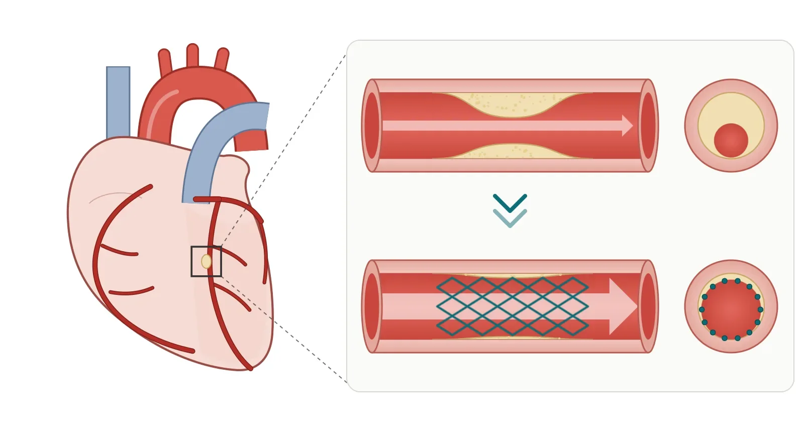 A narrowed coronary artery with plaque compared with the same artery opened by a stent
