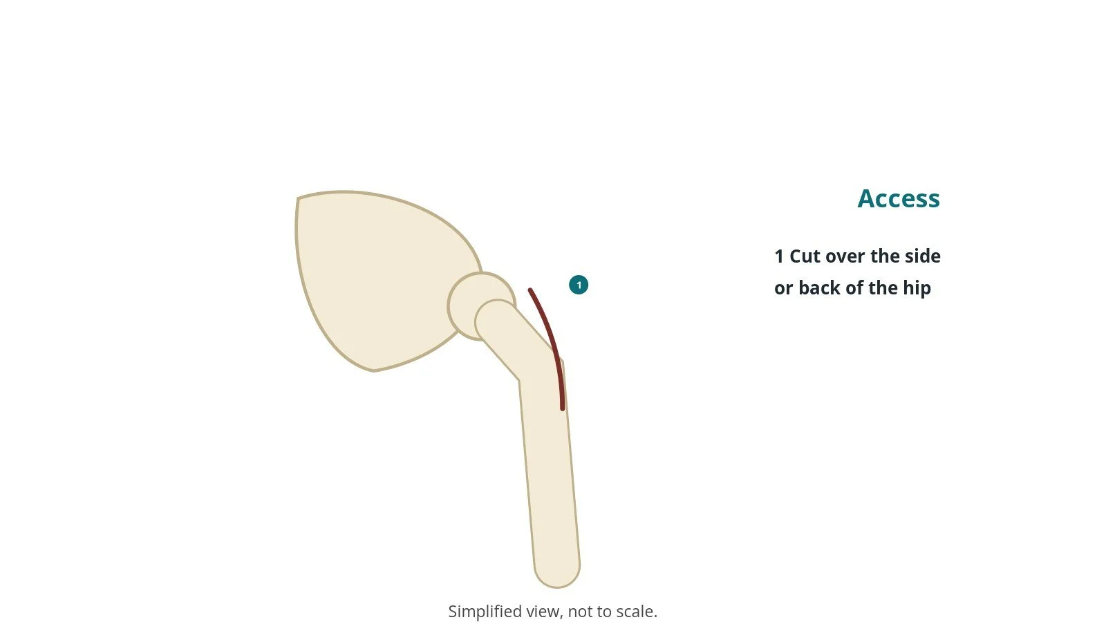Diagram of the hip and pelvis showing an incision line over the side of the hip