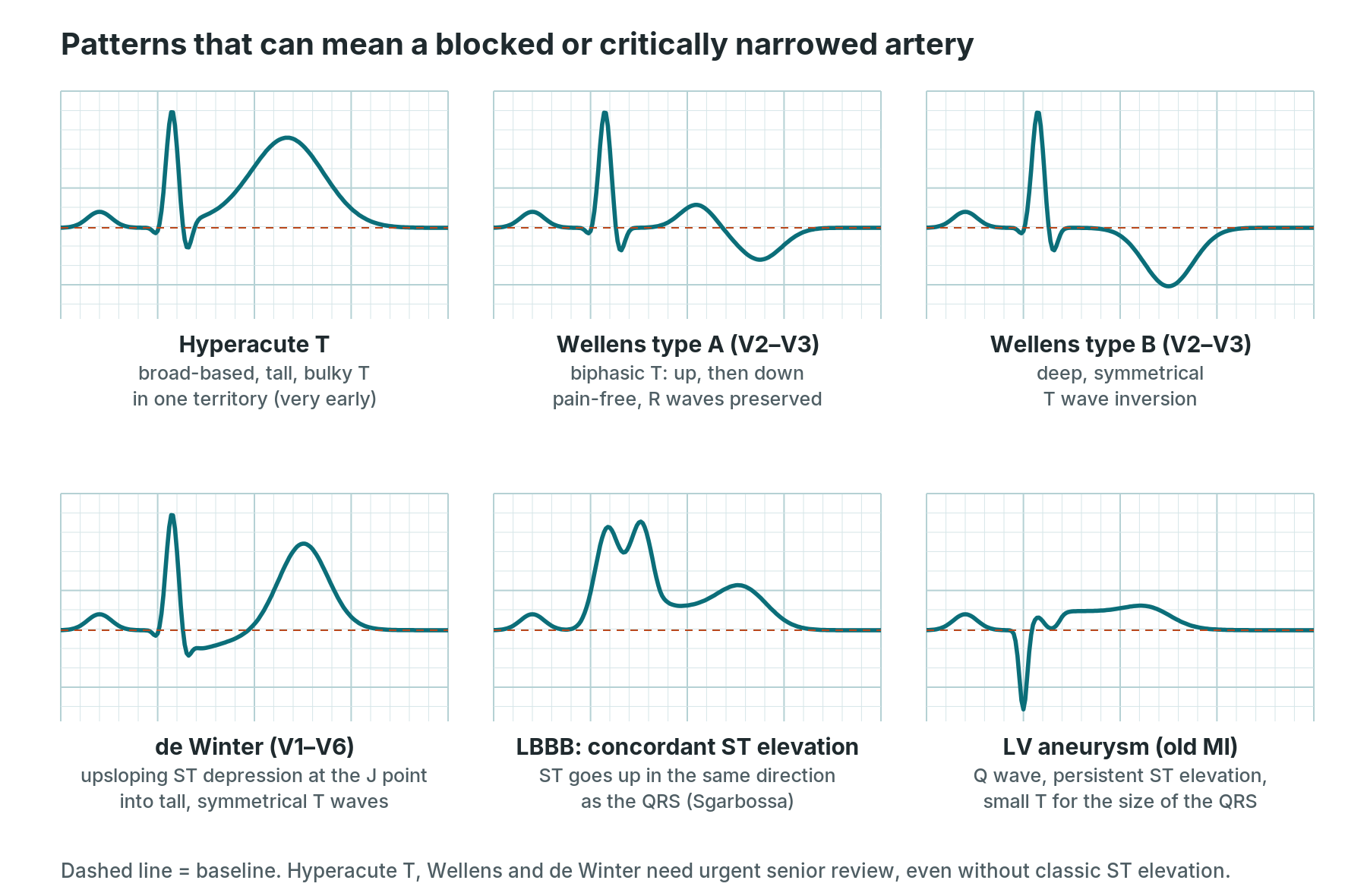 Six simplified beats: hyperacute T wave, Wellens type A and type B, de Winter pattern, concordant ST elevation in LBBB, and LV aneurysm