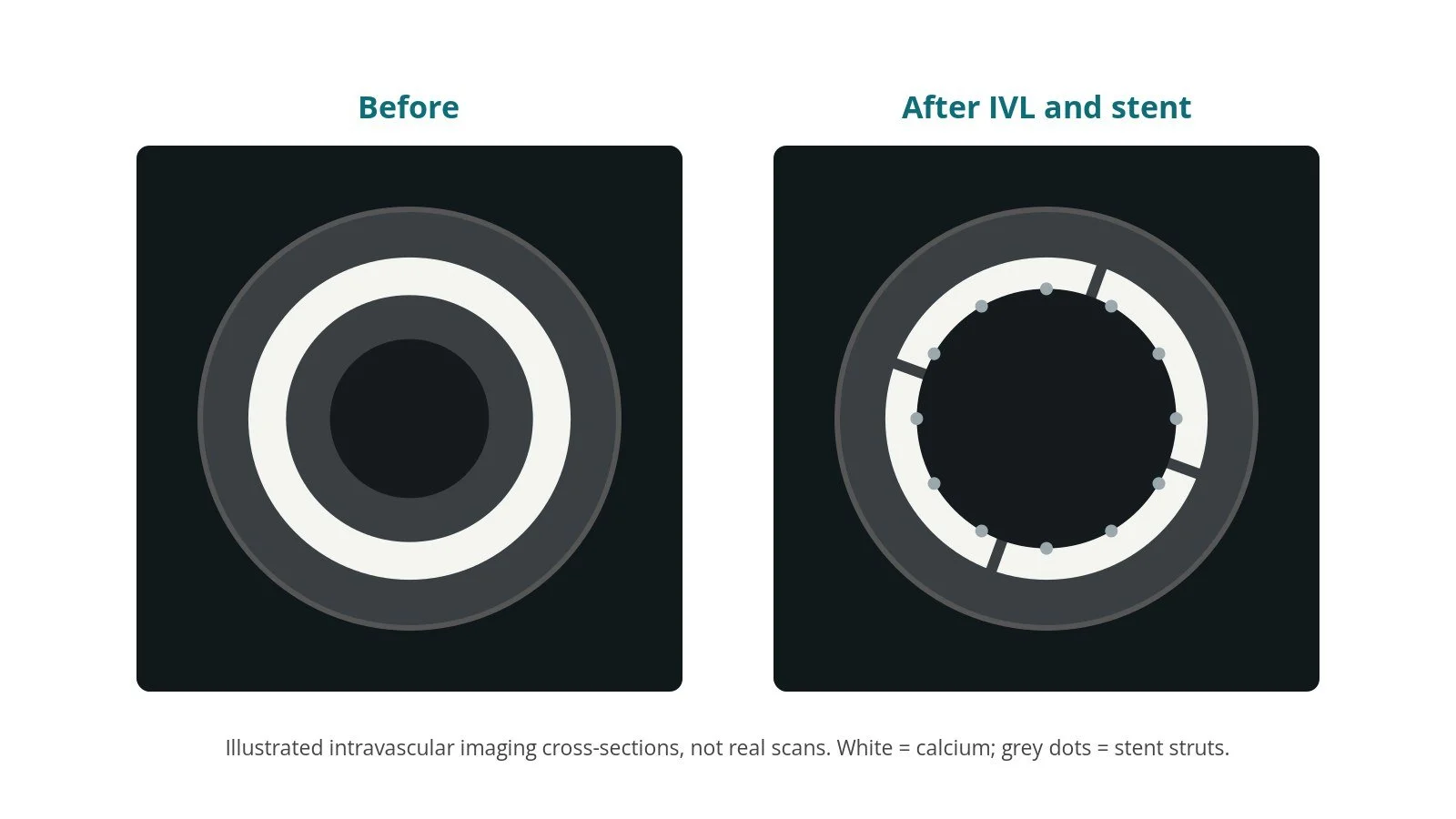 Illustrated intravascular imaging cross-sections: before, an intact ring of calcium; after IVL and stenting, cracks in the calcium and a round, fully expanded stent