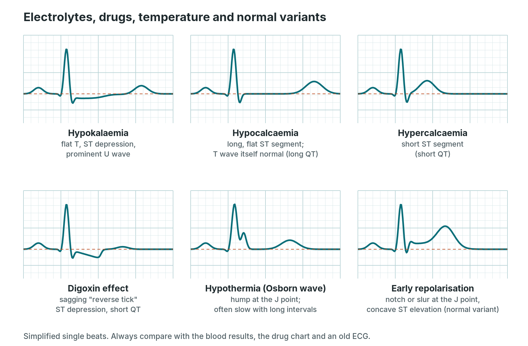 Six simplified beats: hypokalaemia with U wave, hypocalcaemia, hypercalcaemia, digoxin effect, hypothermia Osborn wave and early repolarisation