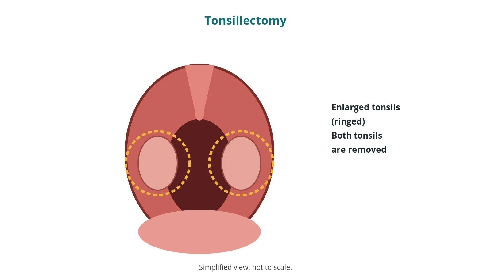 Diagram of an open mouth showing both enlarged tonsils at the back of the throat, ringed