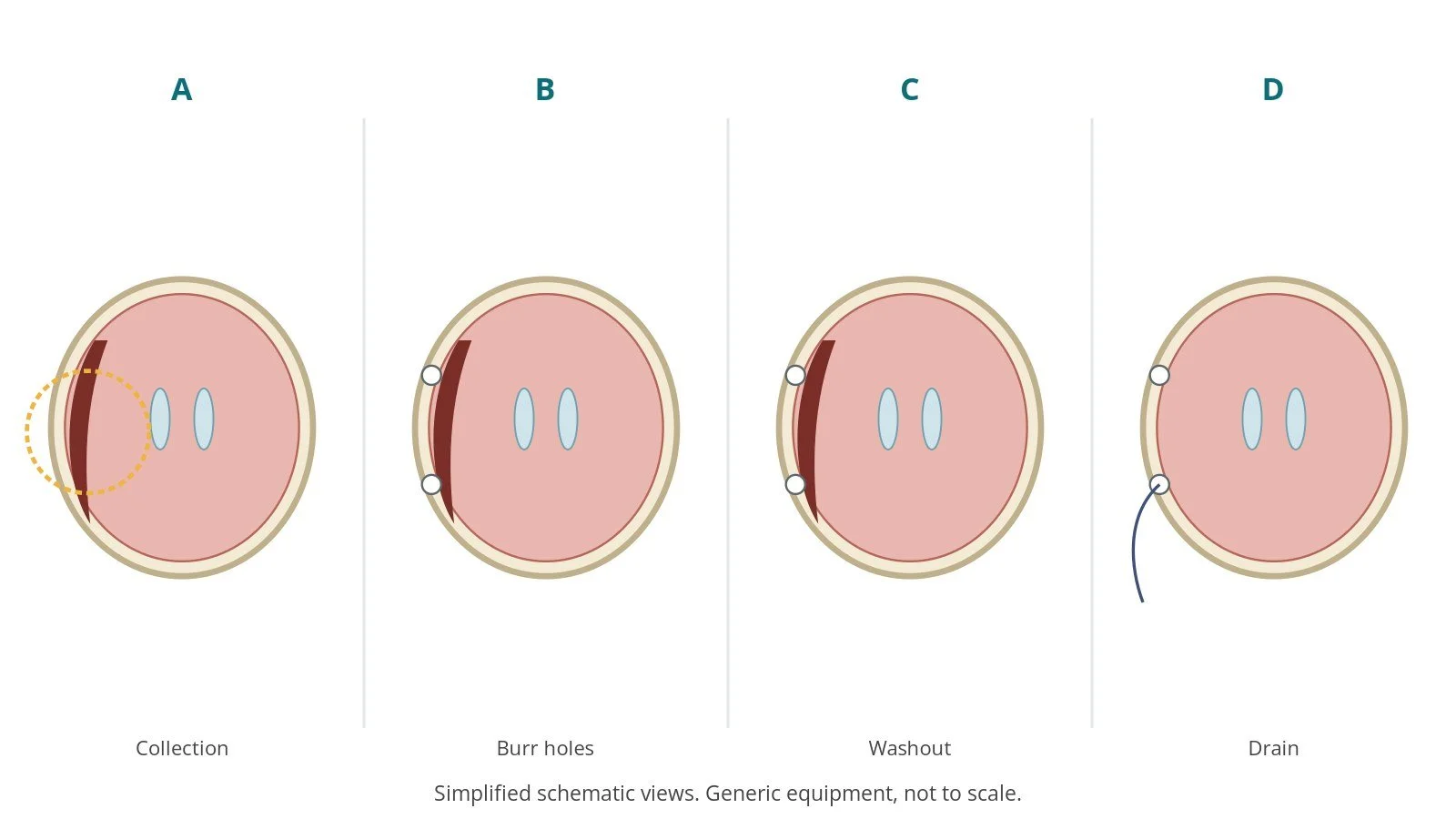 Four-panel schematic of burr hole surgery: collection, burr holes, washout, drain