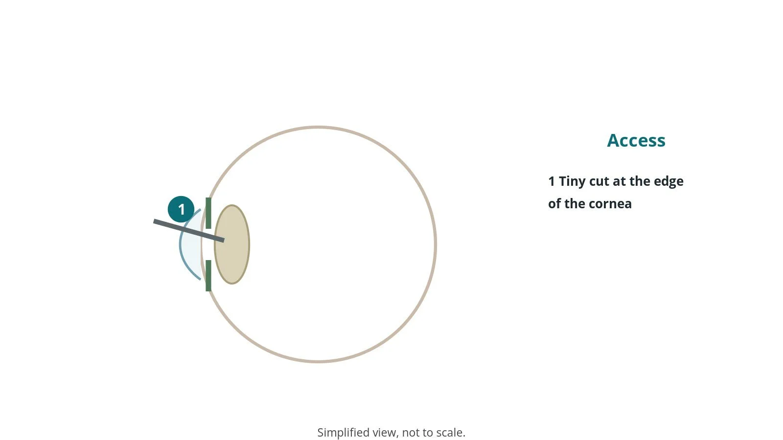 Diagram of a side view of the eye with a phaco probe entering through a small corneal cut to the lens