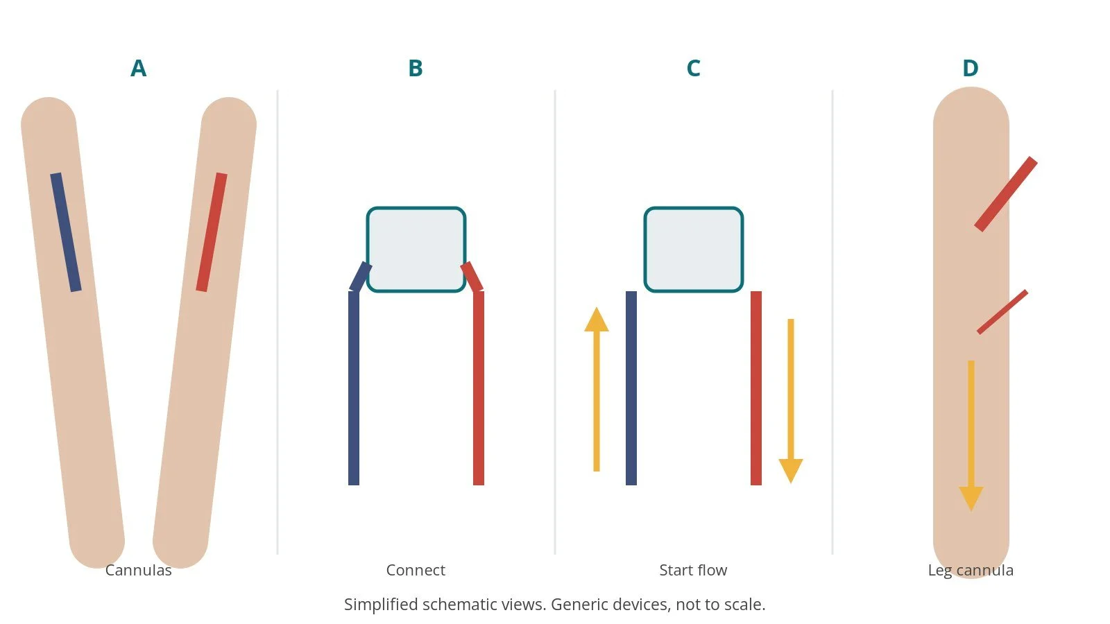 Four-panel schematic of ECMO cannulation: cannulas, connect, start flow, leg cannula