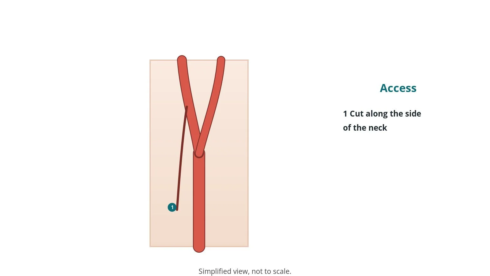 Diagram of the neck arteries showing an incision line along the side of the neck over the carotid artery