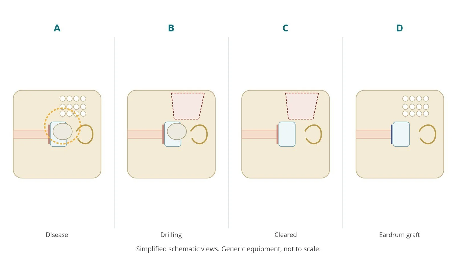 Four-panel schematic of mastoidectomy and tympanoplasty: disease, drilling, cleared, eardrum graft