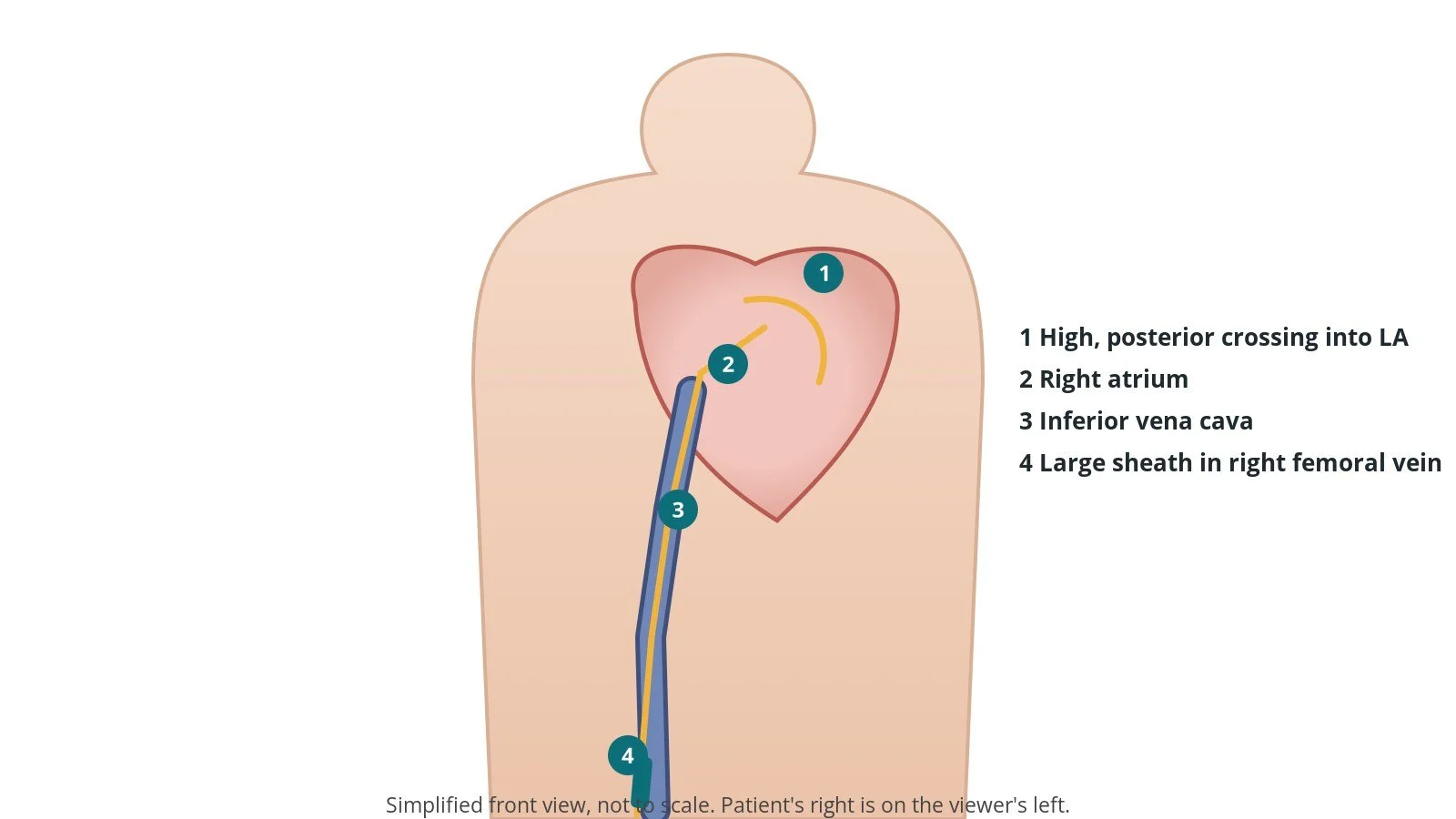 Front view of a patient showing a catheter from the right femoral vein up the inferior vena cava, across the atrial septum into the left atrium and towards the mitral valve