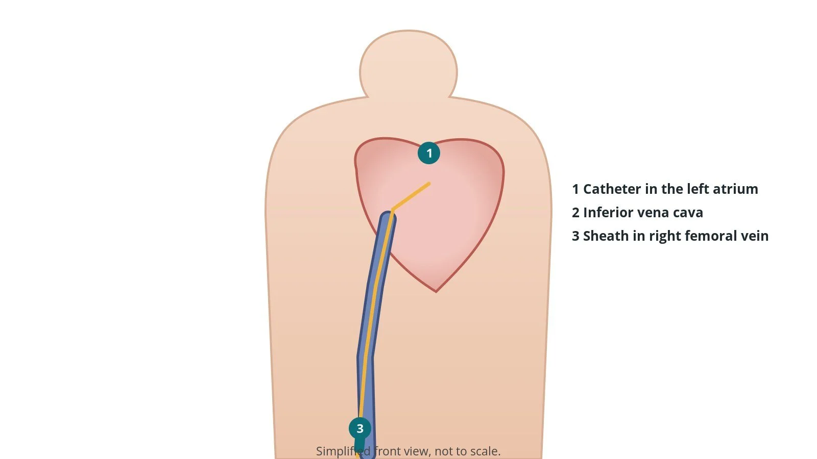 Front view of a patient showing a catheter from the right femoral vein in the groin up the inferior vena cava to the right side of the heart