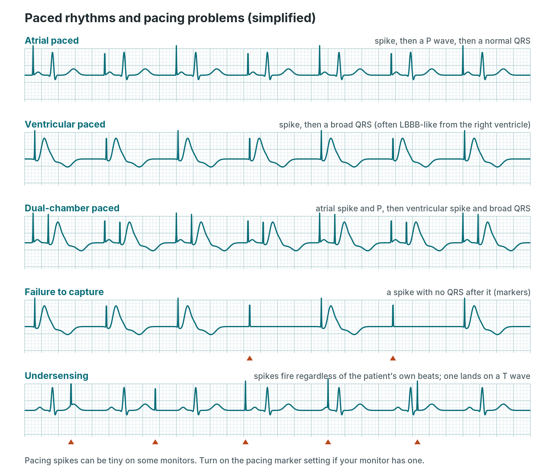 Simplified strips of atrial paced, ventricular paced and dual-chamber paced rhythms, failure to capture and undersensing