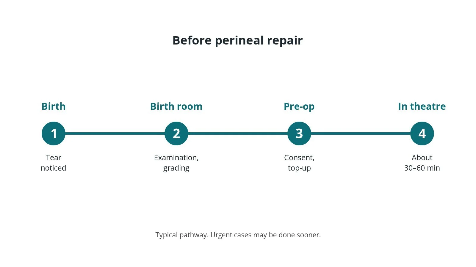 Timeline of the usual steps before perineal repair: Birth: Tear noticed, Birth room: Examination, grading, Pre-op: Consent, top-up, In theatre: About 30–60 min