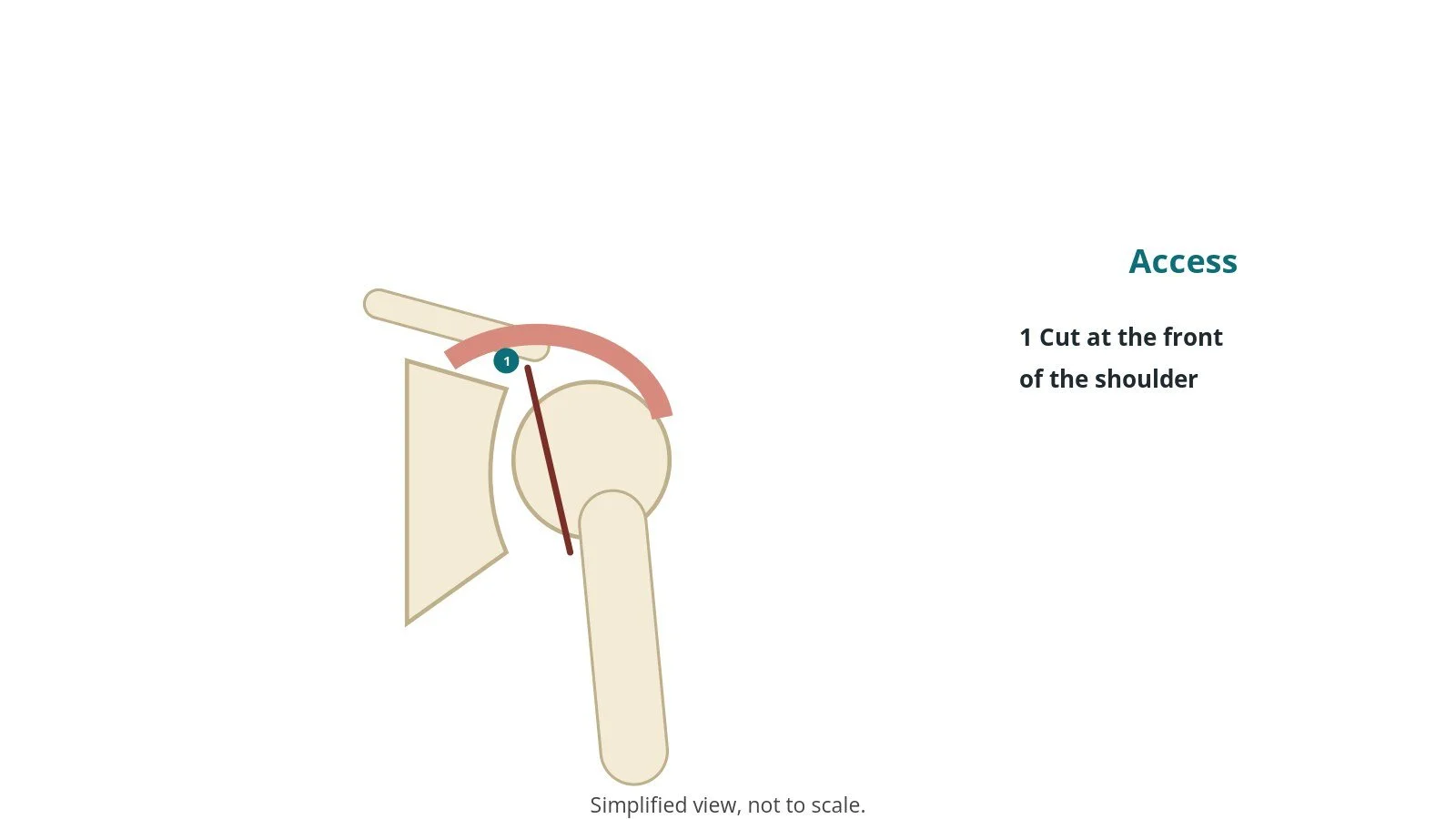 Diagram of the shoulder showing an incision line at the front of the shoulder