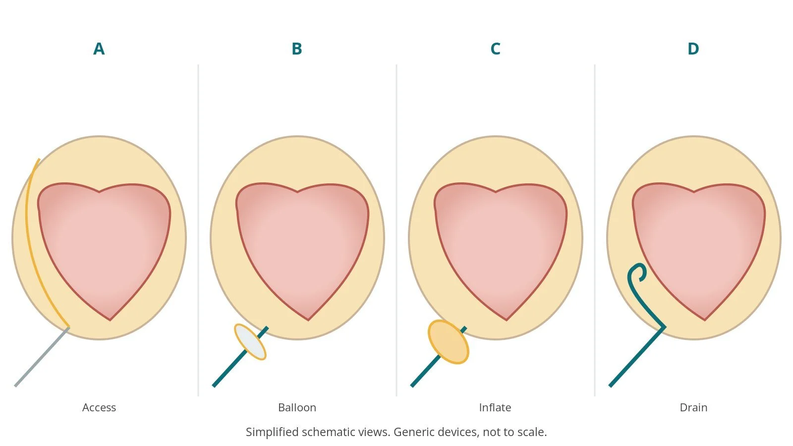 Four-panel schematic of a percutaneous pericardial window: access, balloon, inflate, drain