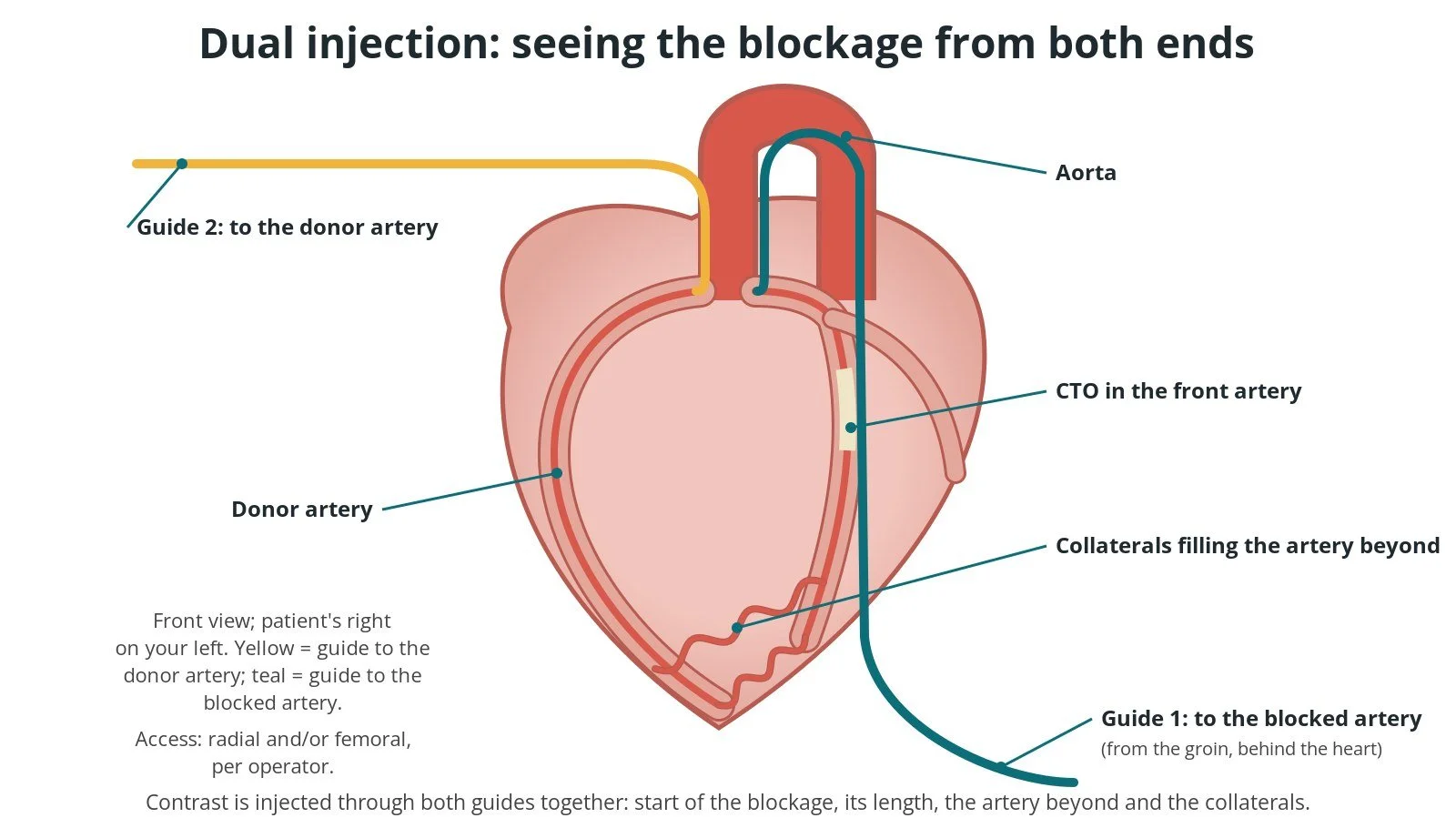 Front view of the heart with one guide catheter in the blocked front artery and a second guide catheter in the donor artery, whose collaterals fill the artery beyond the blockage
