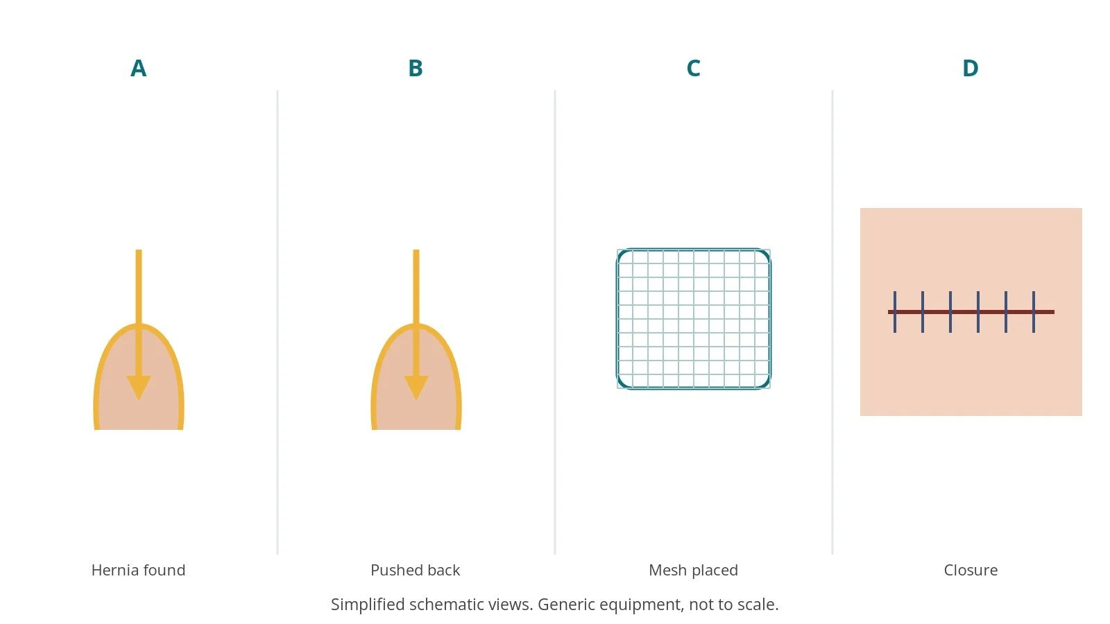 Four-panel schematic of inguinal hernia repair: hernia found, pushed back, mesh placed, closure