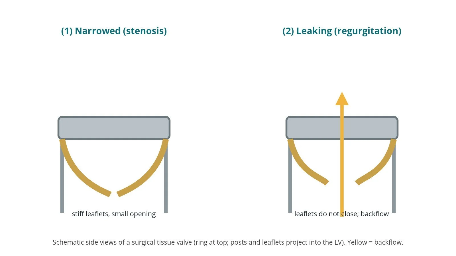 Two diagrams of a surgical tissue mitral valve: worn leaflets narrowed and stiff, and worn leaflets leaking
