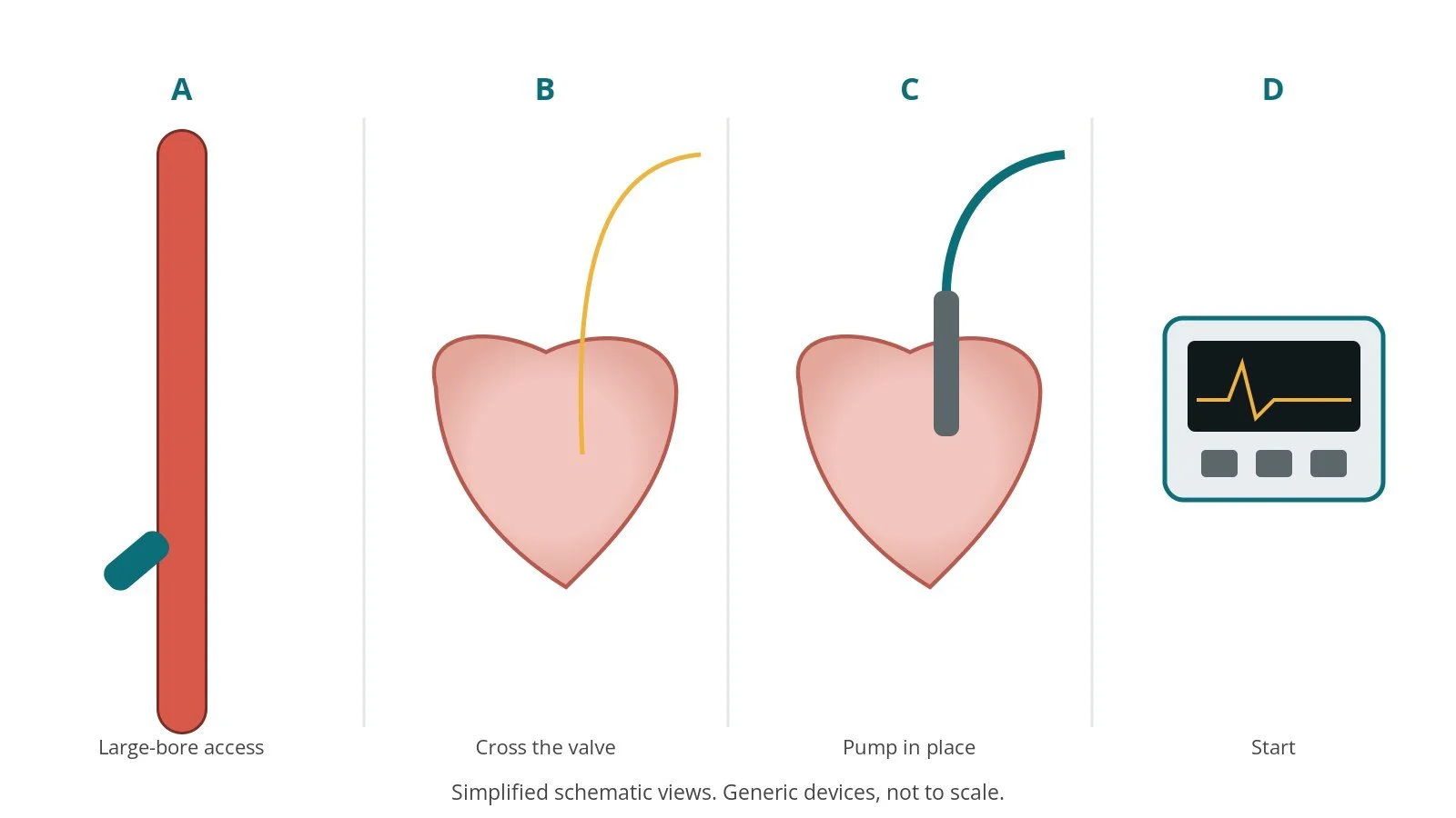 Four-panel schematic of percutaneous LV support device insertion: large-bore access, cross the valve, pump in place, start