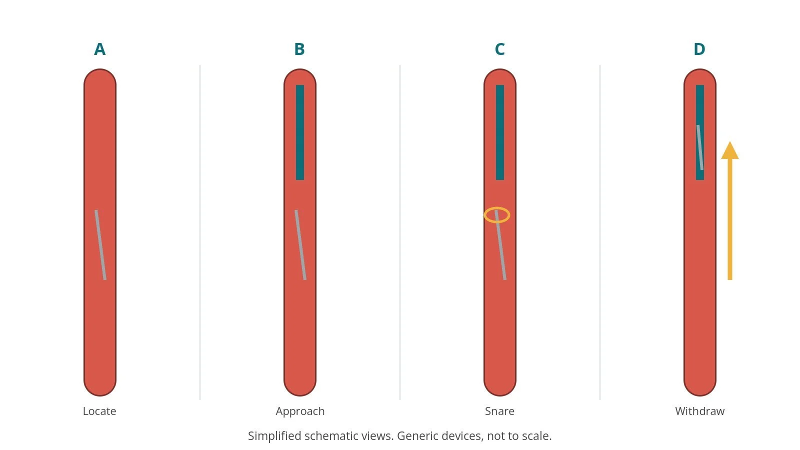 Four-panel schematic of foreign body retrieval: locate, approach, snare, withdraw
