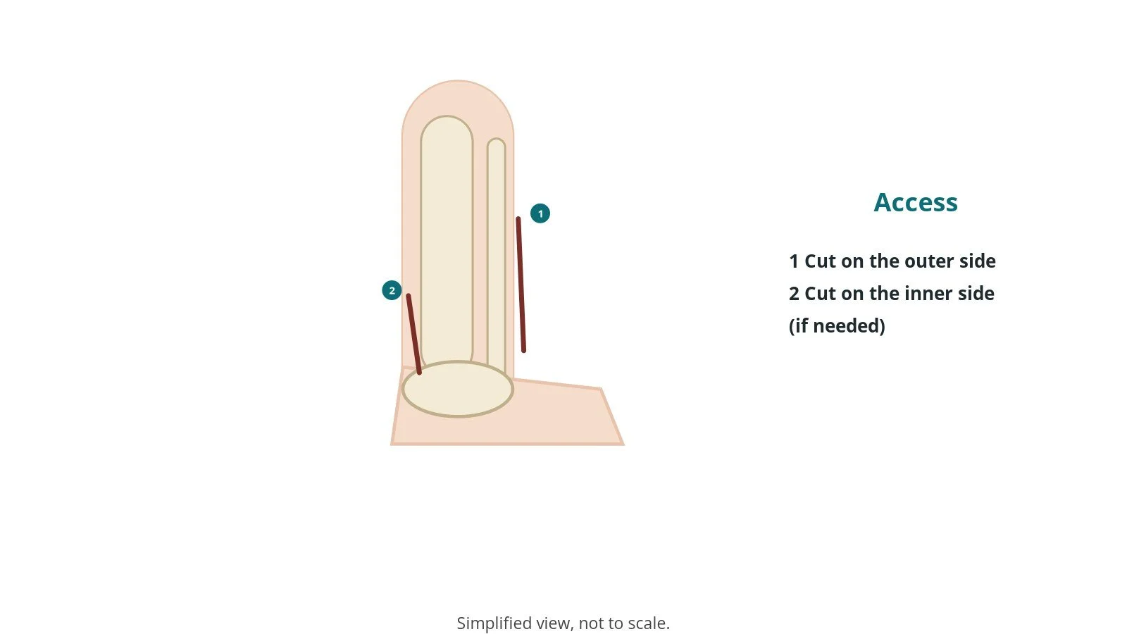 Diagram of the lower leg and ankle showing incisions on the outer and inner sides of the ankle