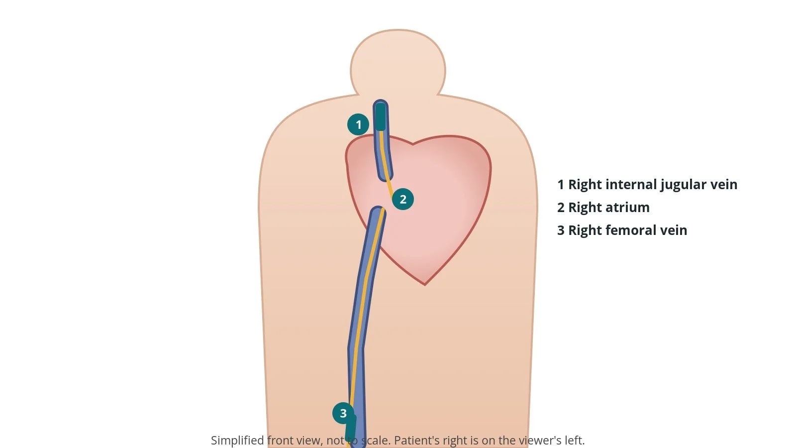 Front view of a patient showing access through the right internal jugular vein in the neck and the right femoral vein in the groin, both leading to the right atrium