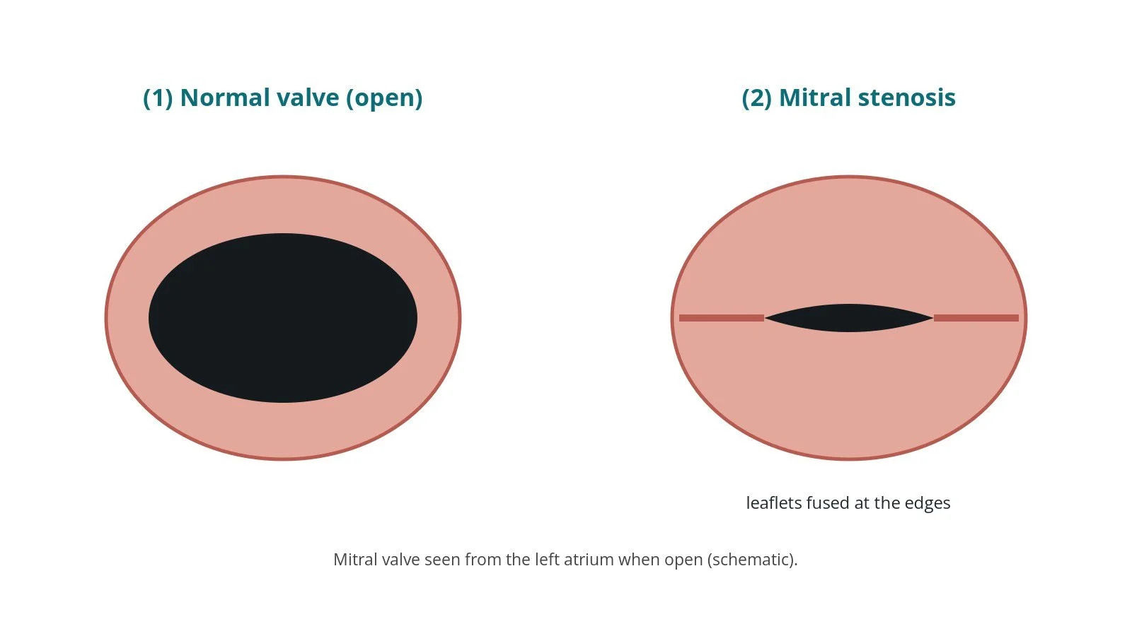 Two views of the mitral valve from above: a normal wide opening, and mitral stenosis with thickened leaflets fused at the edges leaving a narrow opening