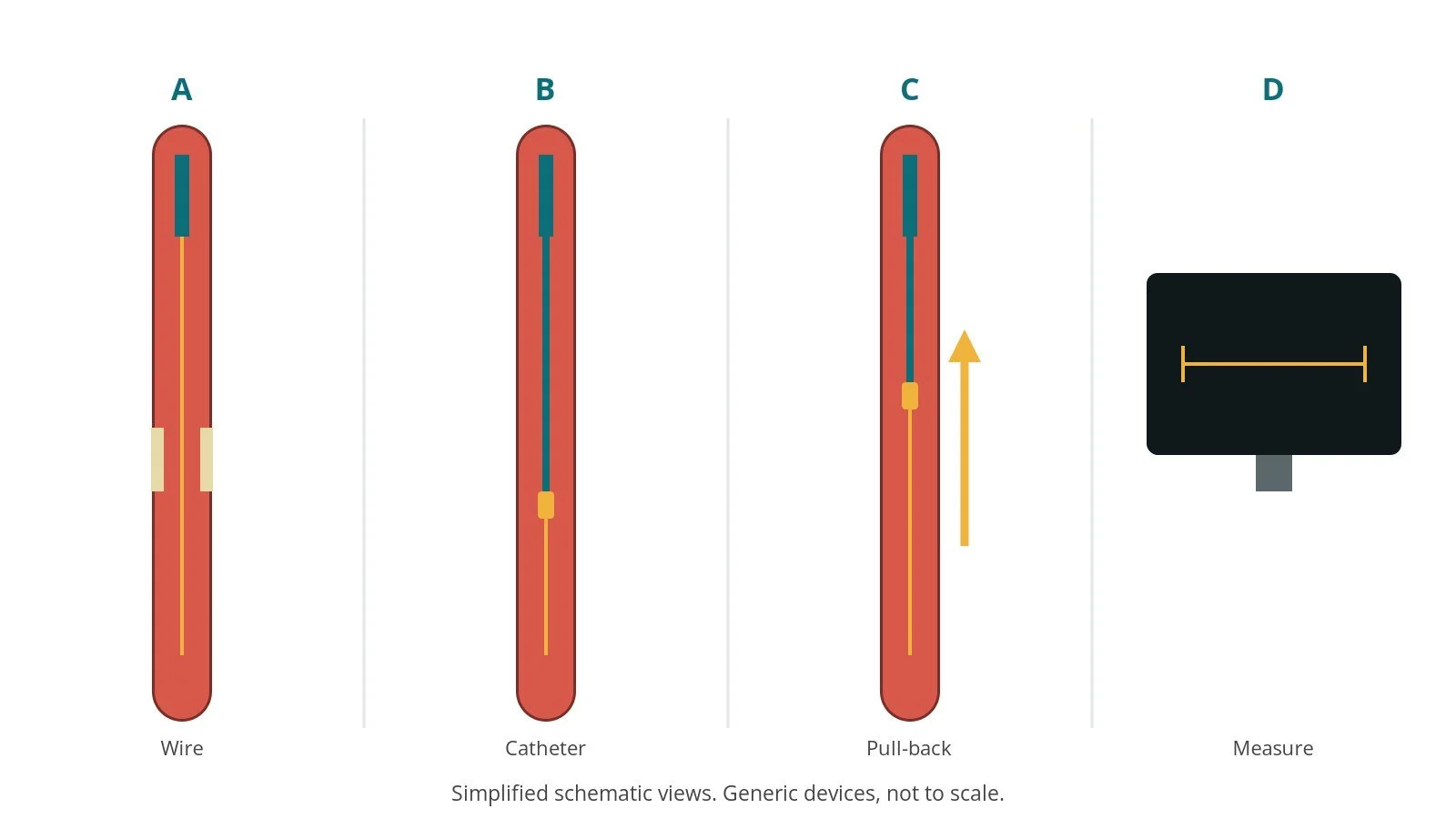 Four-panel schematic of IVUS: wire, catheter, pull-back, measure