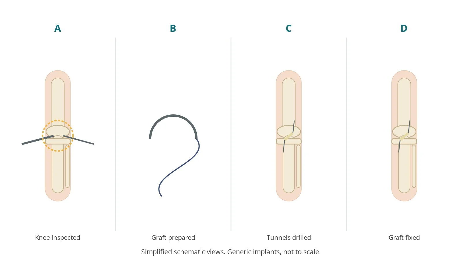 Four-panel schematic of ACL reconstruction: knee inspected, graft prepared, tunnels drilled, graft fixed