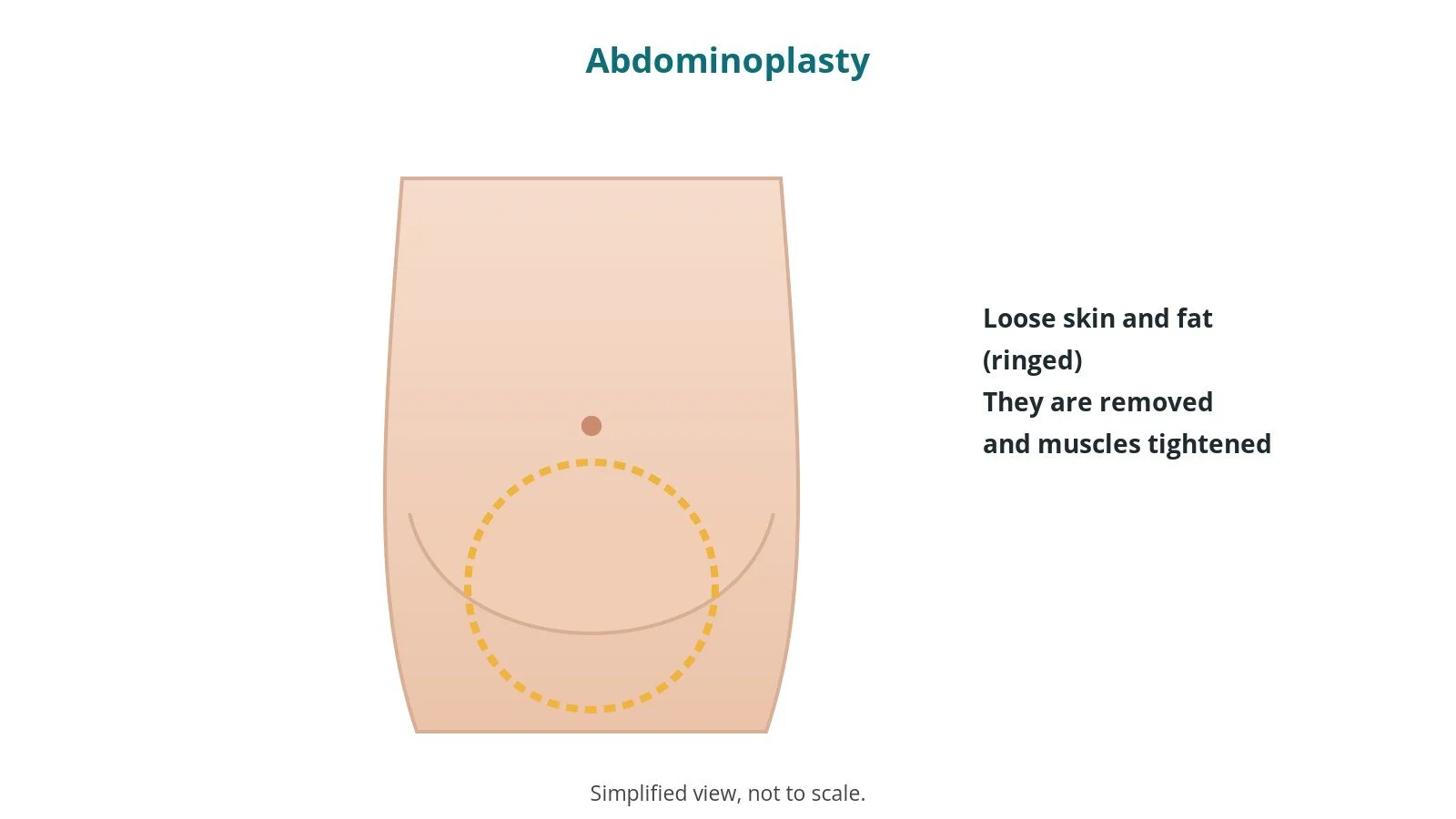 Simplified outline diagram of the abdomen with loose lower skin and fat ringed