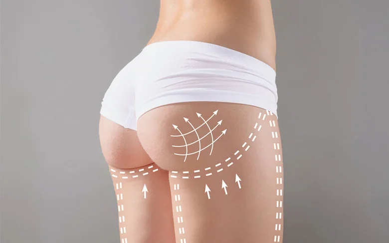 Lser cellulite.jpg