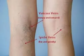 Difference-between-spider-veins-and-varicose-viens.jpg