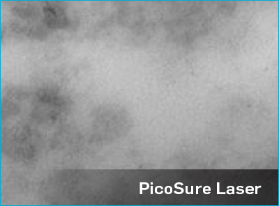 PicoSure Laser.png
