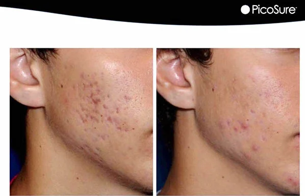 PicoSure Acne.jpg