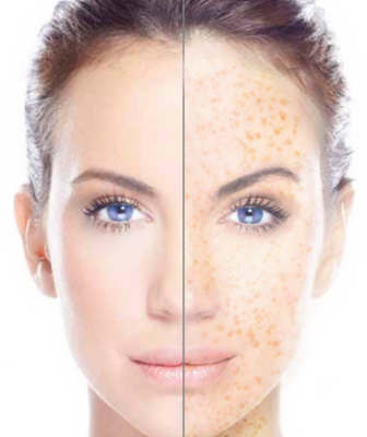 freckles before and after.png