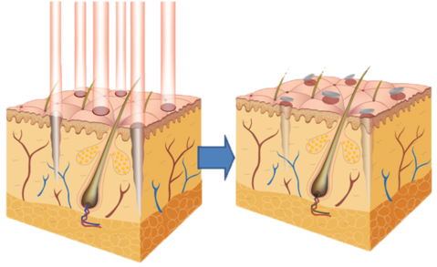 1550 Erbium Laser Beam .png
