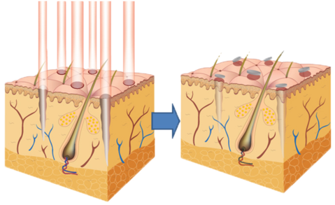 1550 Erbium Laser Beam .png