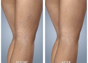 Best-effective-safe-painless-IPL-laser-red-spider-vein-removal-on-the-North-Shore-of-Sydney.jpg
