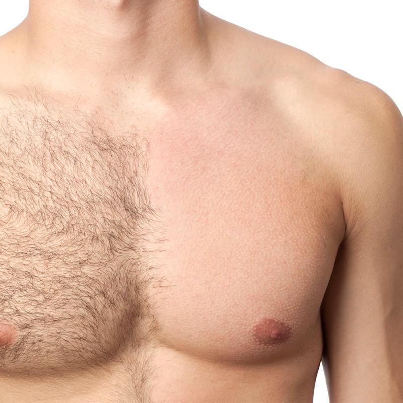 Male Candela Laser Hair Removal 30% off | Star Medispa