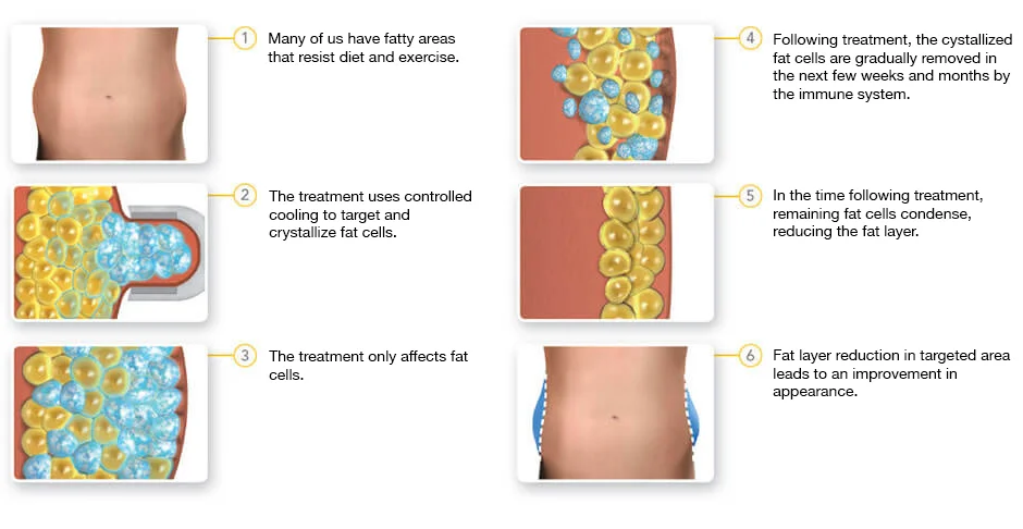 Cyrolipolysis Fat Reduction | Star Medispa