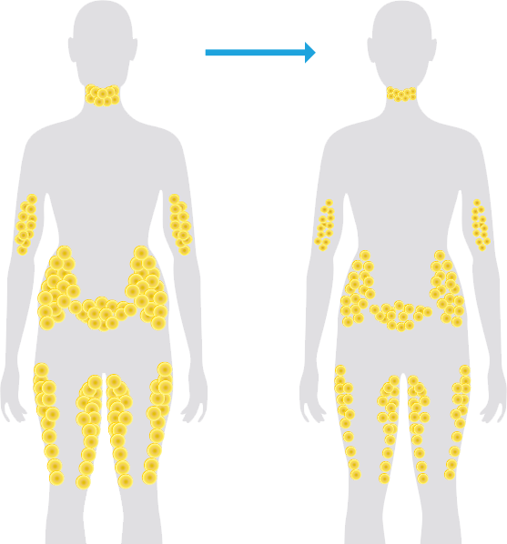 1060 Laser Body Slimming.png