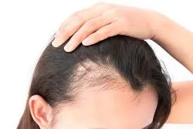 hair loss.jpeg